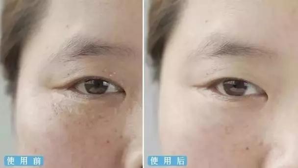 脂肪粒别用针挑教你一个土办法,脂肪粒怎么用针挑出来不疼