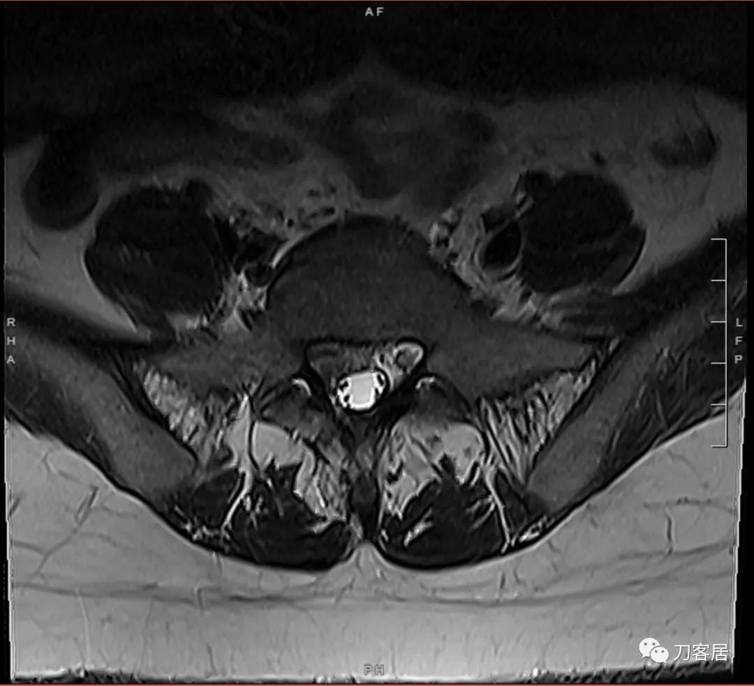椎间孔镜微创手术13天,椎间孔镜微创手术患者