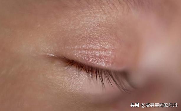 婴儿眼屎多怎么做局部护理,新生儿眼屎多如何护理