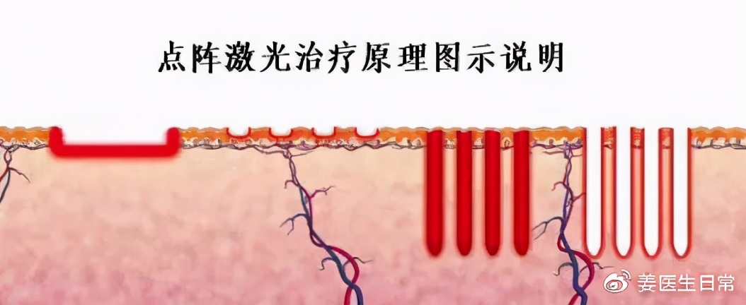 已经形成的疤痕增生怎么去掉,疤痕为什么越长越大