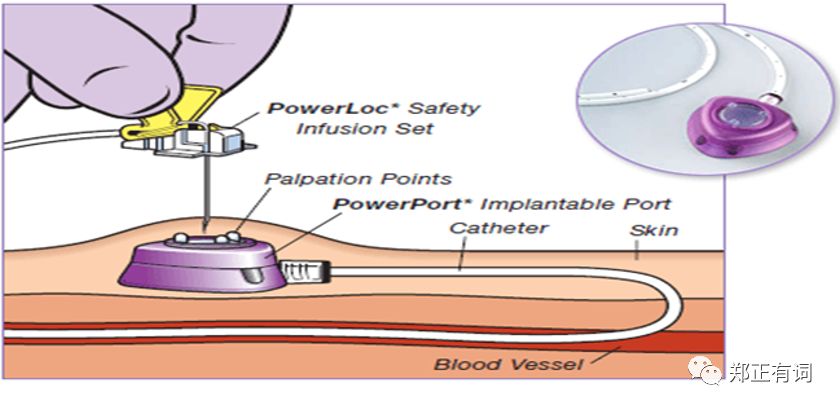 静脉输液港植入是治疗什么病的,静脉输液港植入术