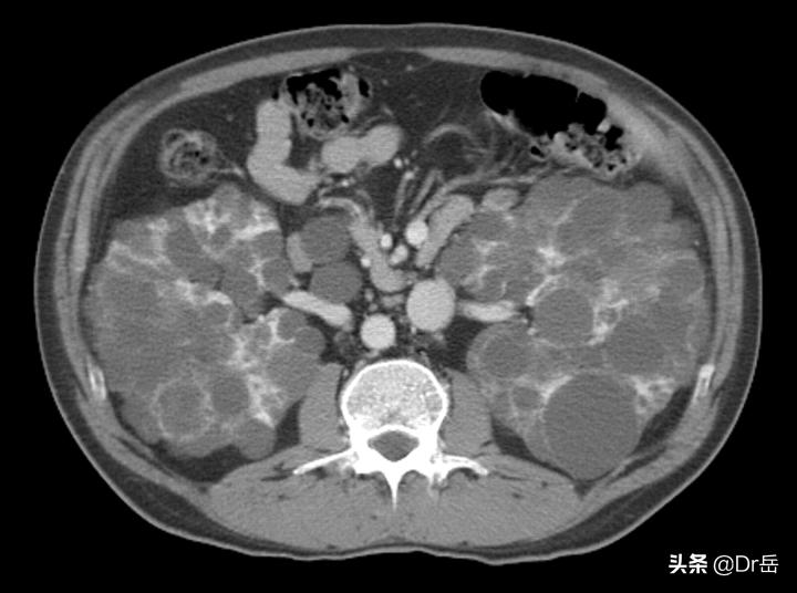 多囊肾肌酐130到尿毒症有多长时间,多囊肾肌酐179能控制多久到尿毒症