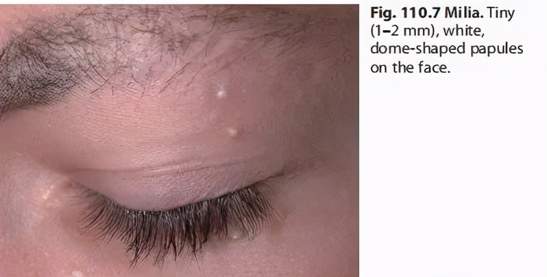 脸上长了闭口小颗粒怎么去除,脸上白色颗粒怎么去除