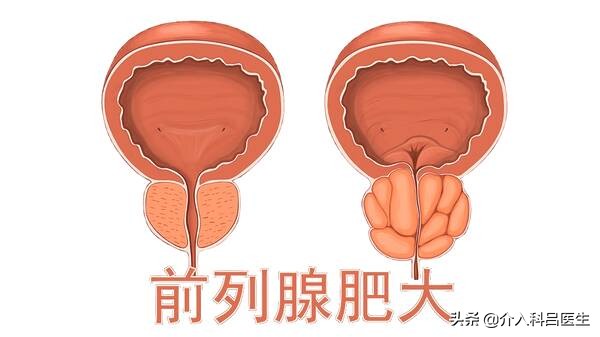 介入治疗前列腺增生，效果显著还微创！为何大医院也极少开展？