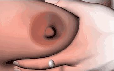 「哺乳问题」乳头皲破咋办？解决方法来了