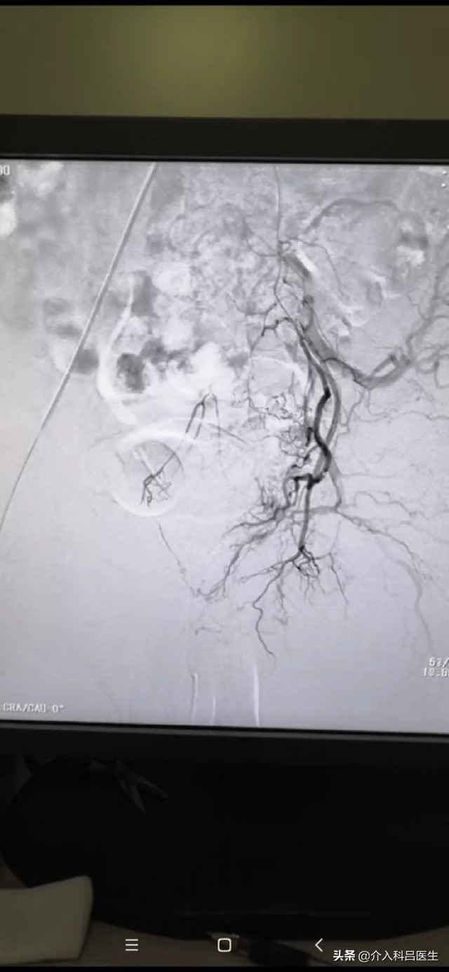不死的癌症子宫腺肌瘤,子宫腺肌症介入栓塞效果和后遗症