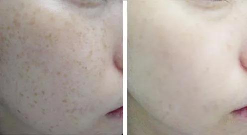 祛色斑的小窍门,色斑严重学会这几招省钱又有效