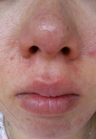 鼻头上的白色小颗粒用什么药去除,鼻头的白色小颗粒怎么消除