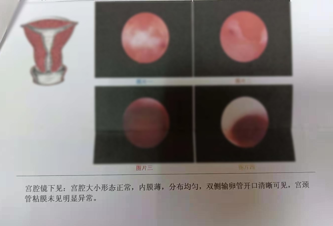 子宫内膜薄产后会内膜厚吗,人流后多年发现子宫内膜厚薄不均