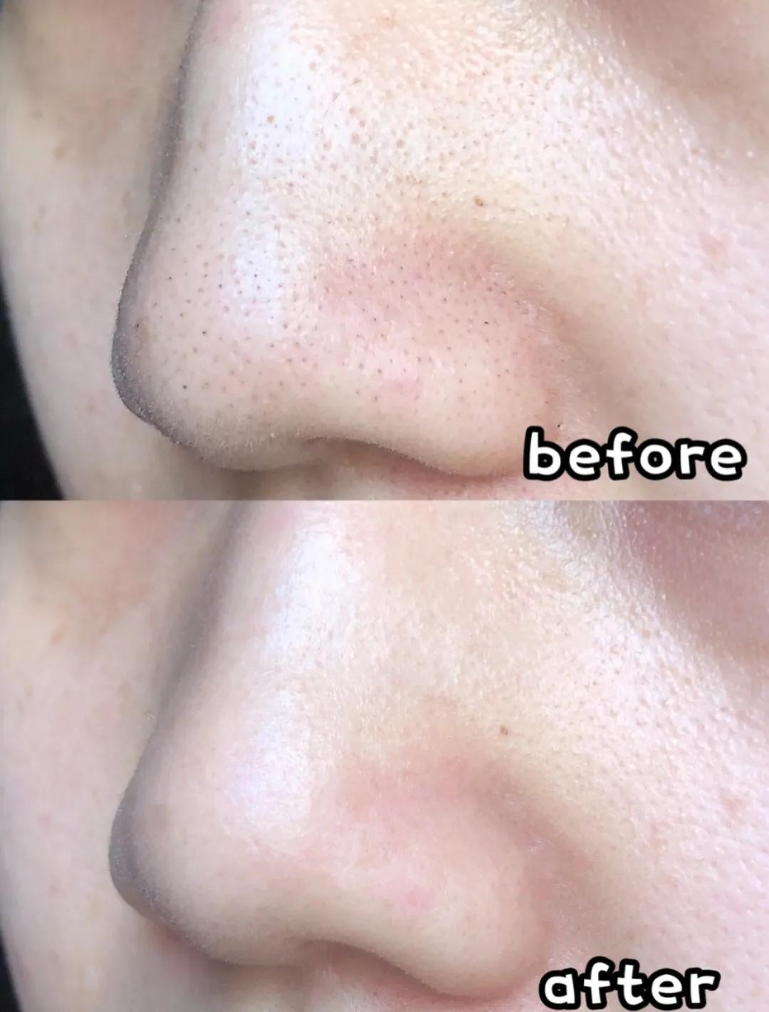 亲测真正有效去黑头粉刺产品,黑头连根拔起还会再长吗