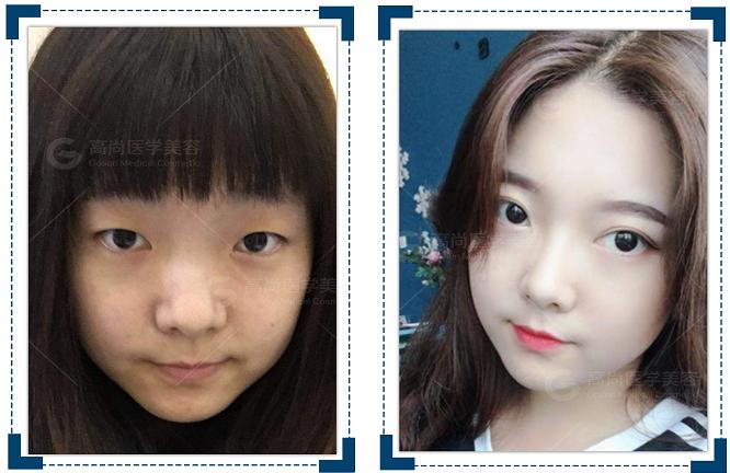 割双眼皮对面相有改变吗,割双眼皮对面相好吗