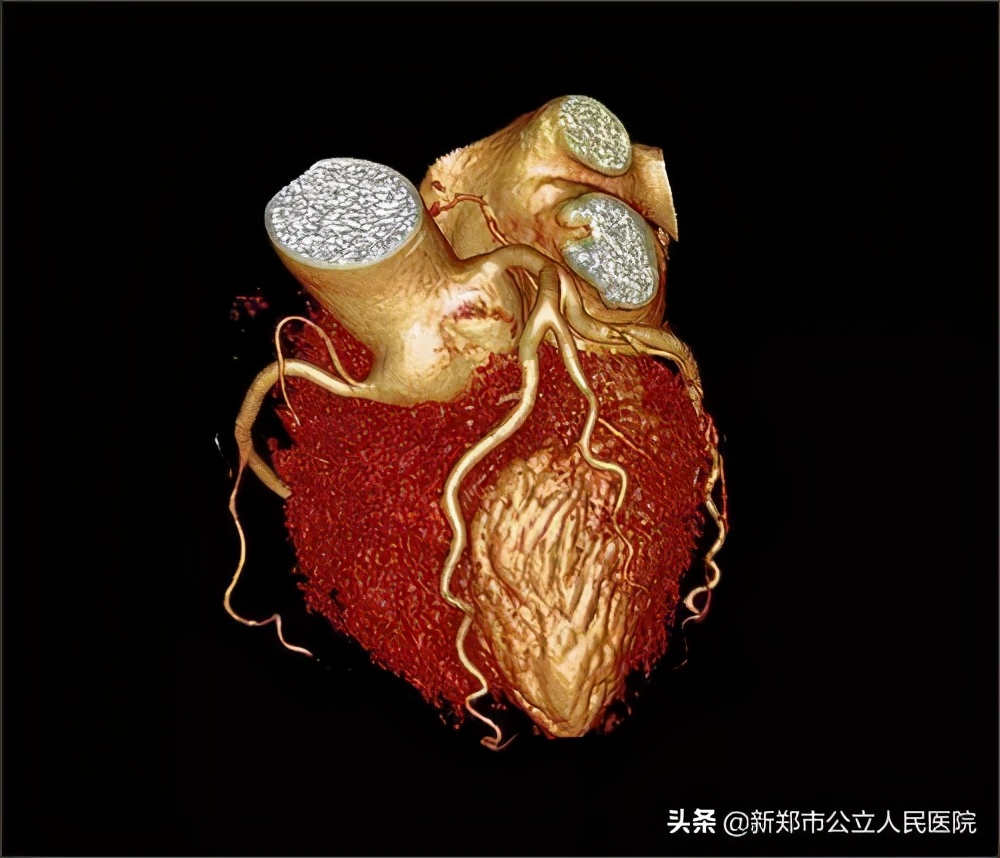 冠脉造影科普宣讲,冠脉CT血管造影