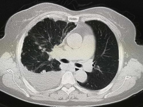 女子胸腔长奇怪肿瘤,女人胸腔积水