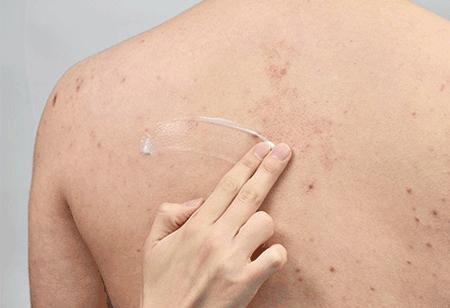 果酸精华改善鸡皮肤,医院果酸换肤鸡皮肤能用吗