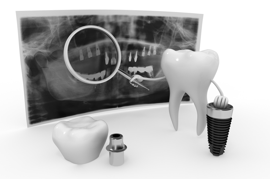 种植牙太遭罪有没有好的假牙,种植瑞士半口牙大概多少钱