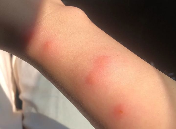 手臂起小疙瘩是荨麻疹,腿上起丘疹性荨麻疹水肿