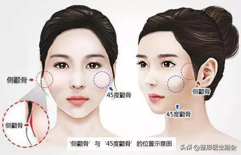 颧骨特别高长胖会不会变好,颧骨高是否特别容易显老