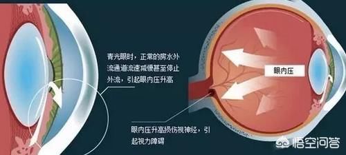 儿童散光和青光眼有什么区别,看东西有重影是散光吗青光眼