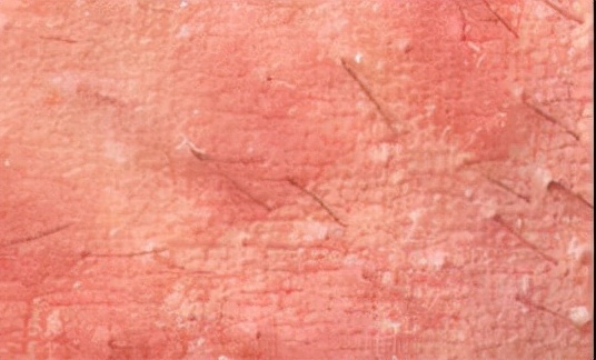 沈阳哪有中医治湿疹好地方,湿疹沈阳中药内调