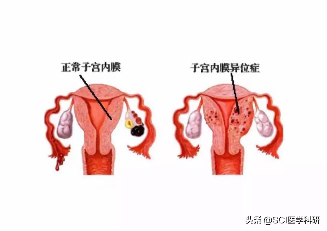 子宫内膜异位症中药能调理吗,米非司酮治疗内膜异位吃多久