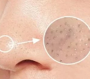 黑头拯救方法无成本,有黑头了该怎么有效去黑头