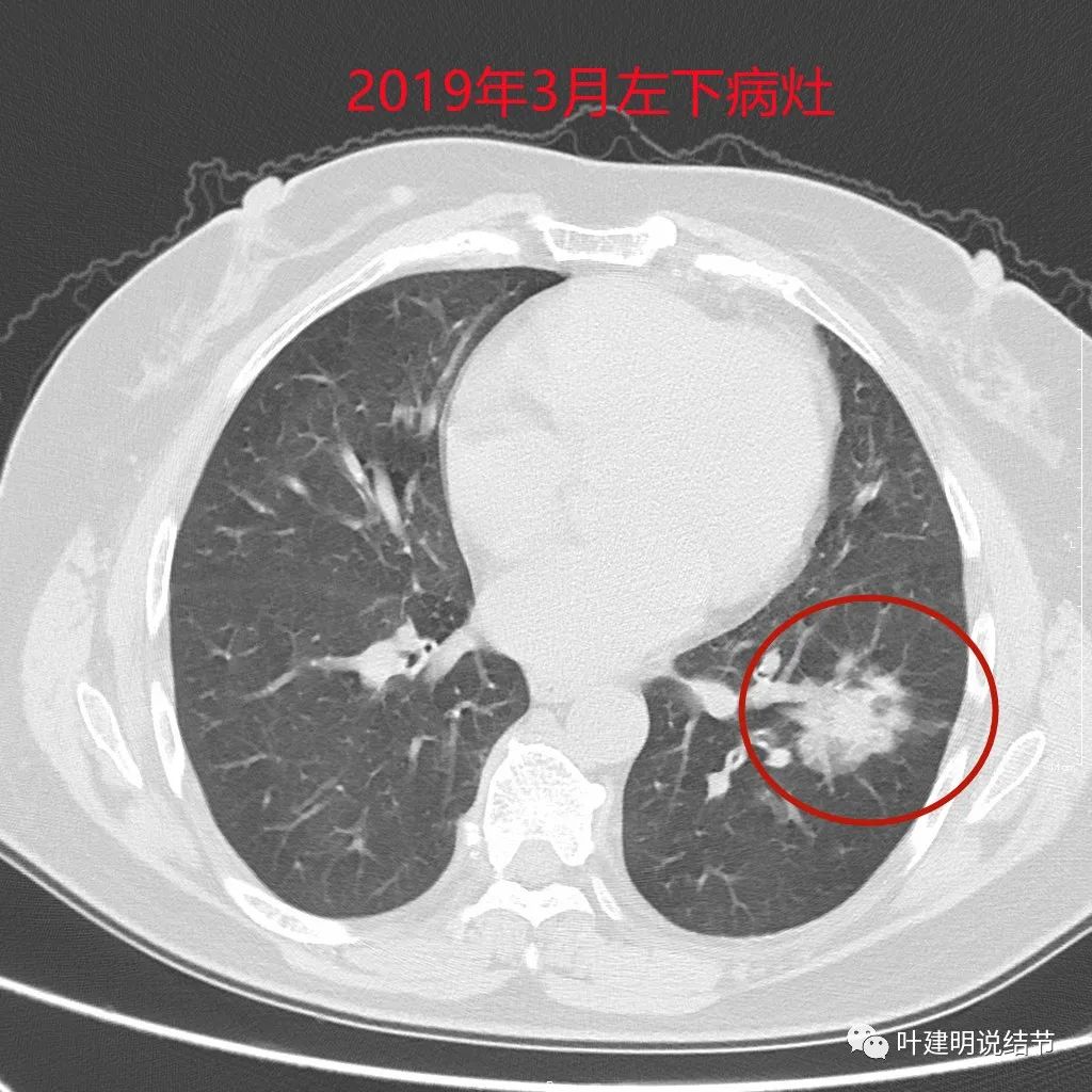 左肺癌手术半年右肺下角还有炎症,左下肺癌晚期