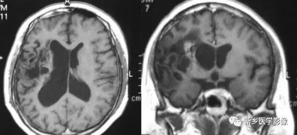 影像学脑室扩大,脑室显大怎么理解