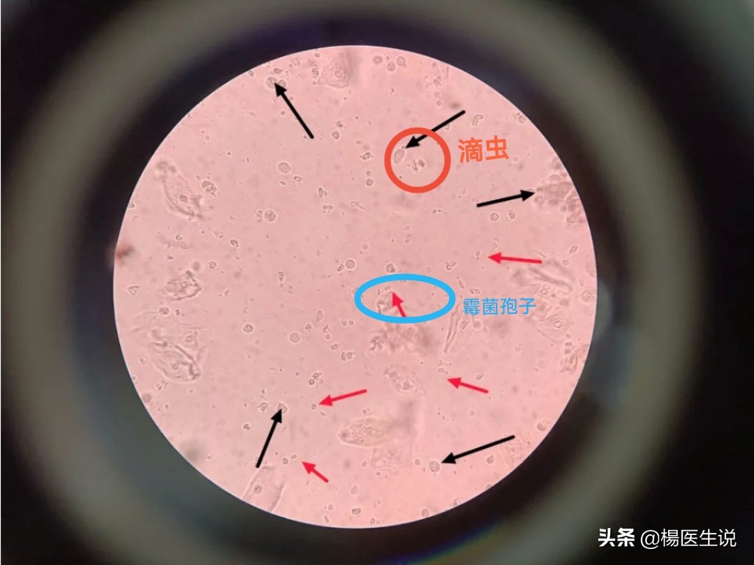滴虫性阴道炎和霉菌性症状区别,滴虫性阴道炎与假丝酵母菌的区别