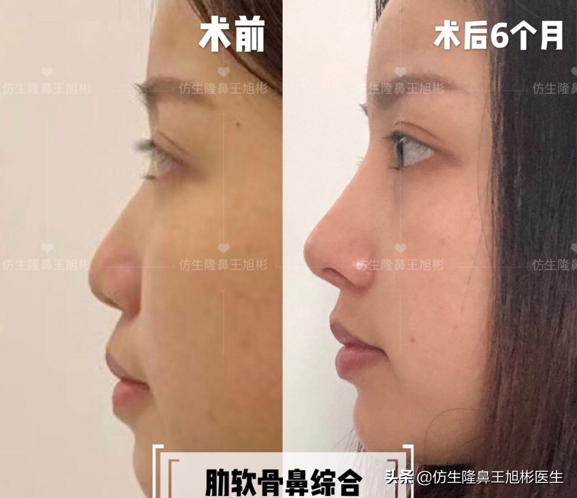 手术鼻头增厚能用什么方法弄,大鼻头高鼻梁缩小手术案例