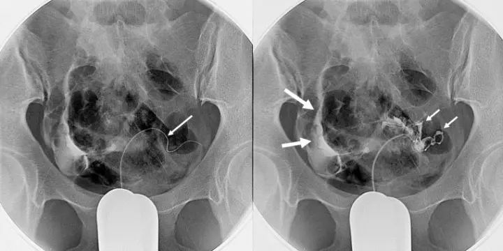 介入手术和微创手术哪个做得更好,无创介入术有哪些