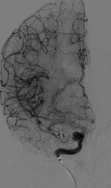 Tubridge®治疗多发性动脉瘤