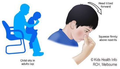 鼻出血怎样才断根,鼻出血的应急处理方式