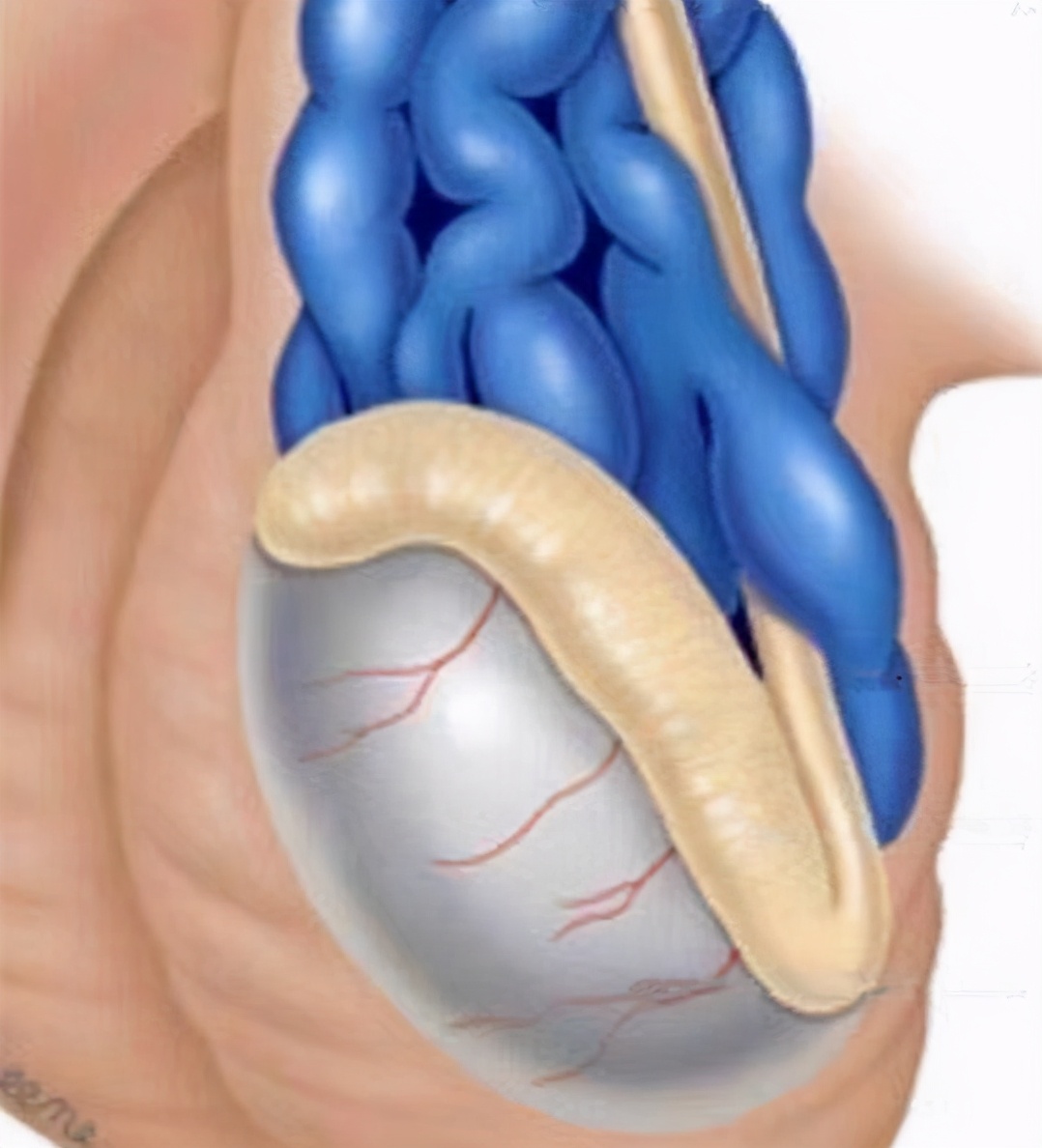 睾丸精索静脉曲张微创手术全过程,睾丸精索静脉曲张手术微创