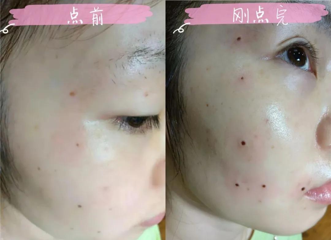 痣多适合什么点痣方法,点痣小妙招一秒点好一个美人痣