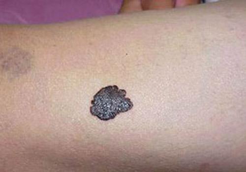 软痣凸起是癌变信号吗,痣变大凸起就一定是要癌变了吗