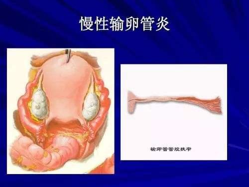 输卵管炎自己平时怎么注意和改善,输卵管发炎不能吃什么