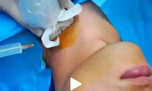 一针治百种病症 (一针治100种病症)