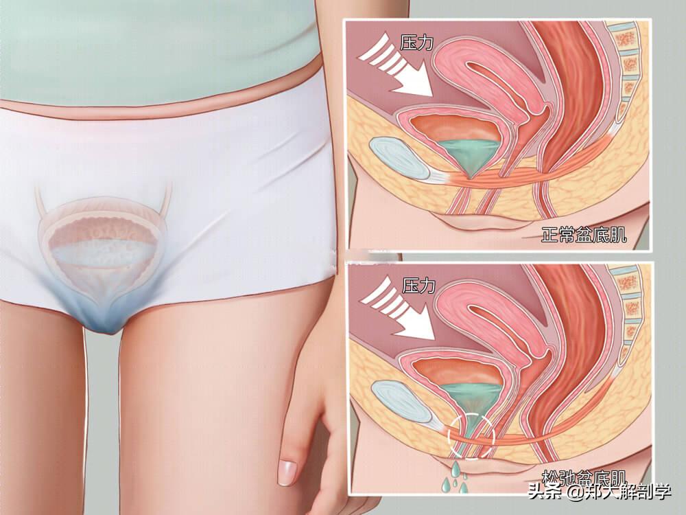 女性盆底功能障碍性疾病表现,盆底功能障碍会引起失眠吗