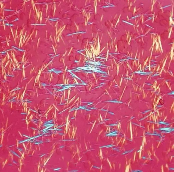 痛风真的有那么可怕吗,痛风到底有多可怕看完全都明白了