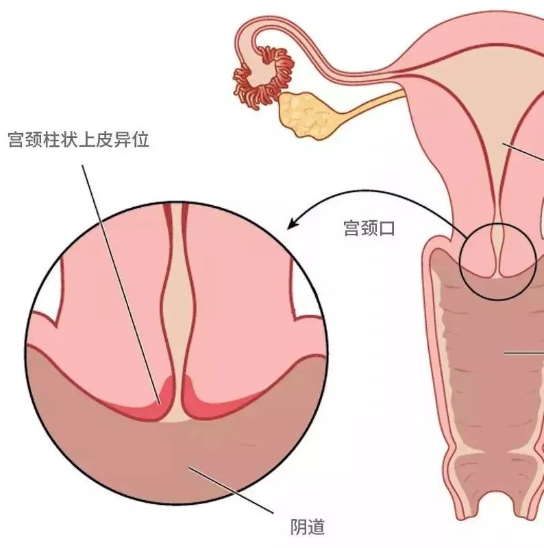 宫颈有点腐烂可以塞药么,医生说我宫颈糜烂挺严重是几度
