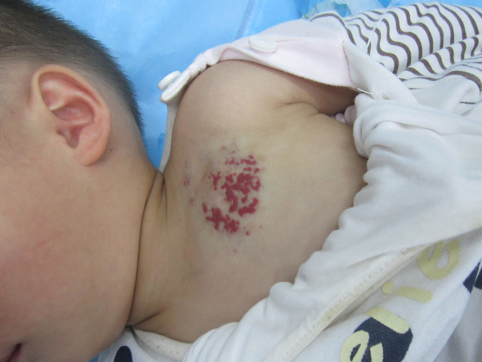 乳房血管瘤用什么方法治最好,乳房上有樱桃状血管瘤怎么治