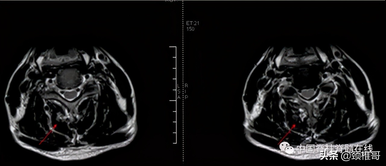 颈椎病的护理临床路径流程图,颈椎病的健康管理与康复指导