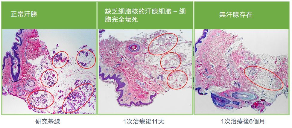 腋下多汗原因和治疗方法,脚手多汗腋窝多汗