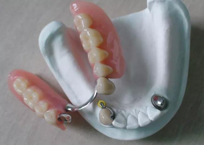 假牙松动重新粘合需要多少钱,种植牙松动可以拔掉重新种吗