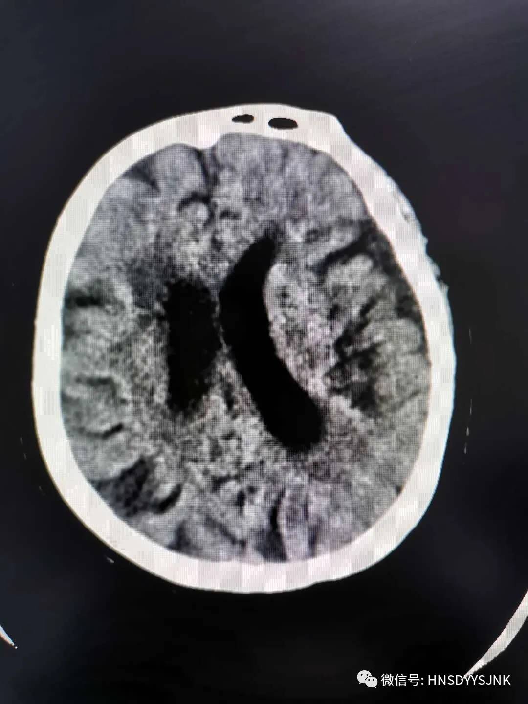 战疫不可掉以轻心,脑卒中为什么4到6小时适合溶栓