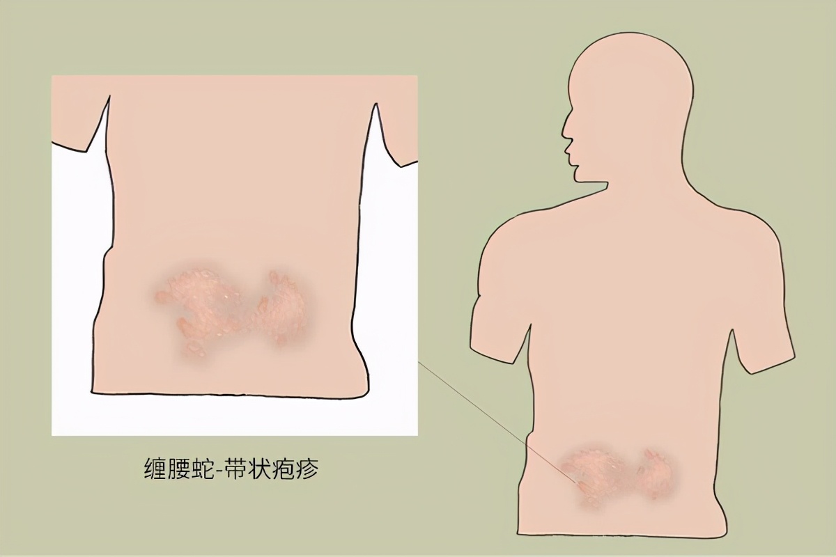 带状疱疹会复发吗复发有什么症状,带状疱疹会复发吗传染吗