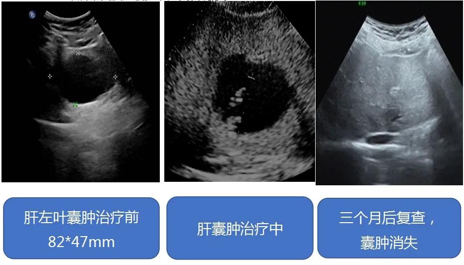 红兴隆中心医院,超声科囊肿治疗视频