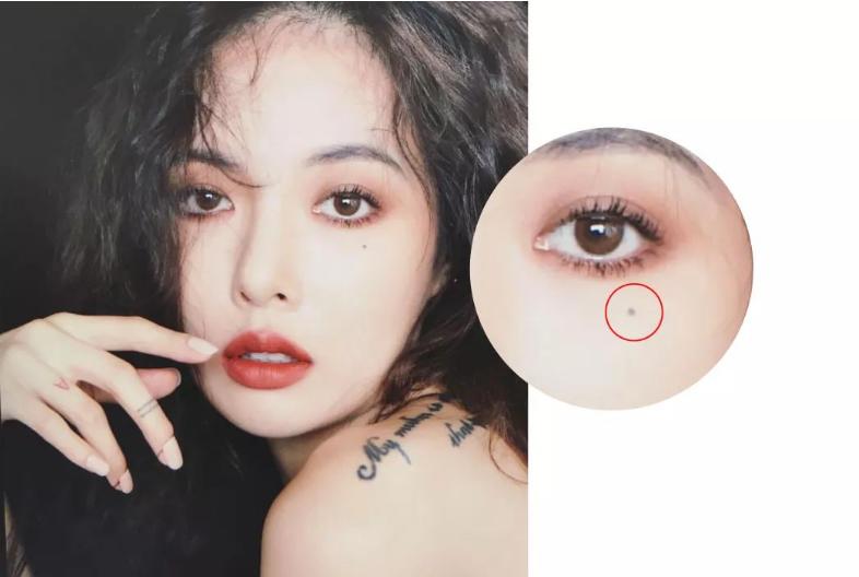 祛痣后需要注意些什么,祛痣后要注意什么不留疤