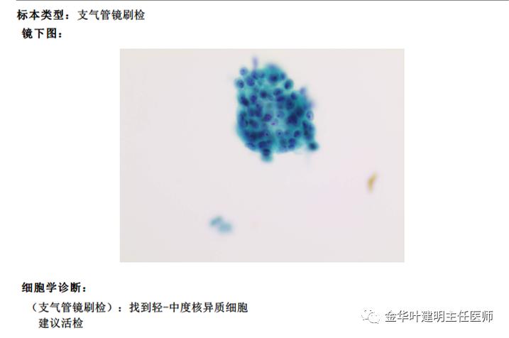 得了肺癌做肺部穿刺有影响吗,肺部穿刺可以确诊肺癌吗