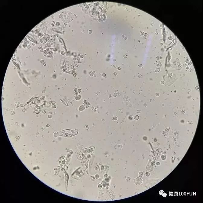 鏈堢粡鏈熷闃翠笉閫忔皵婀跨棐,濡囧コ涓嬮儴婀跨棐鐢ㄤ粈涔堣嵂